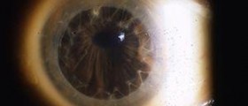 Cornea eye diseases