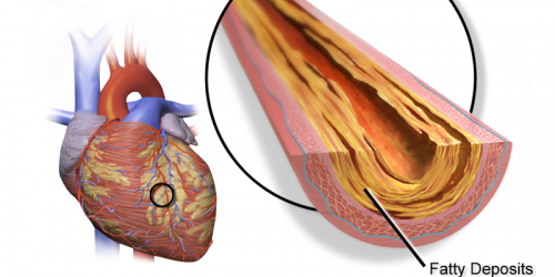 Do Bad Habits Drive Up Your Triglycerides?