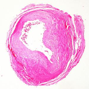 Coronary artery disease symptoms