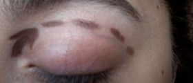 Cosmetic eyelid surgery