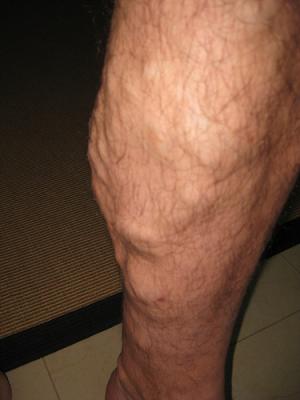 Cosmetic surgery for varicose veins