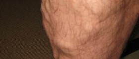 Cosmetic surgery for varicose veins