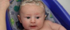 Cradle cap in infants
