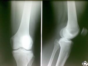 Cruciate ligament surgery