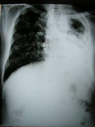 Cure for tuberculosis