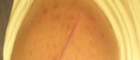 Cutting - Injuring yourself on purpose