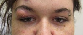 Cystic acne diet