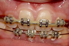 Dental braces care