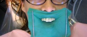 Dental implant procedure explained