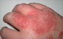 Dermatitis in baby
