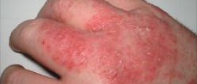 Dermatitis in baby