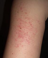 Dermatitis keratosis pilaris