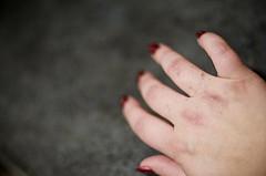 Dermatitis on hands and feet