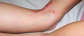 Dermatitis treatment natural
