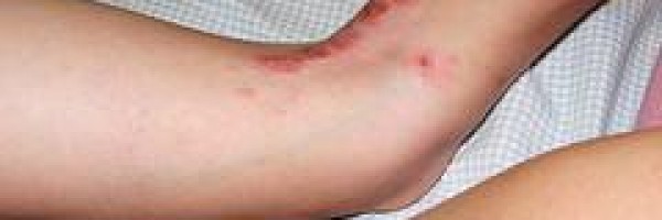 Dermatitis treatment natural