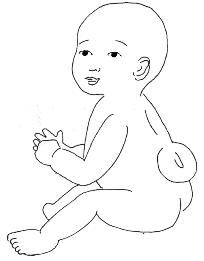 Detection and treatment of Neural tube defects