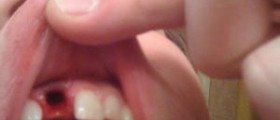Determining what dental implants cost and paying for them
