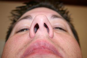 Deviated septum surgery recovery