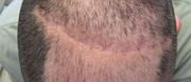 DHT blocker and hair loss
