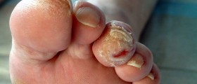 Why Does Diabetes Cause So Many Problems With Feet?