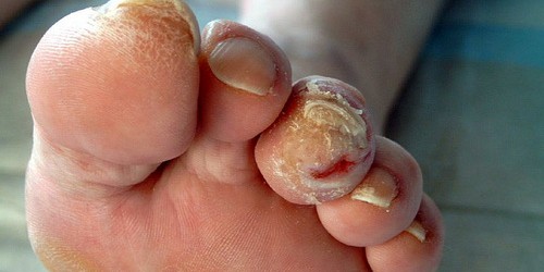 Why Does Diabetes Cause So Many Problems With Feet?