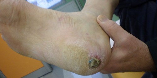 New Treatment Heals Diabetic Skin Wounds Fast