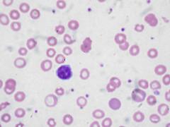 Dietary causes of anaemia