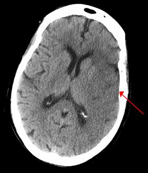 Different treatment options for Cerebral hemorrhage