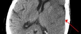 Different treatment options for Cerebral hemorrhage