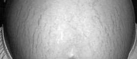Different types of stretch mark treatment