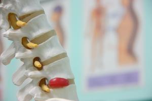 Disc herniation symptoms