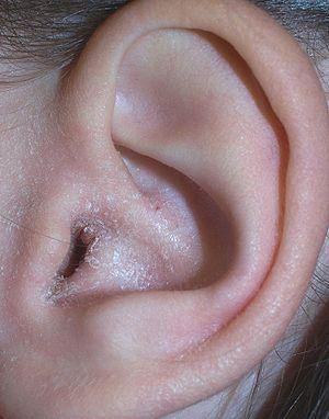 Discoid eczema cure