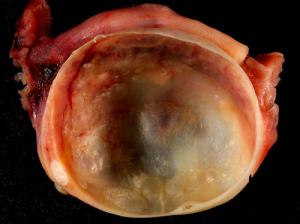 Discover the troublesome symptoms of ovarian cyst's bursting