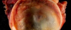 Discover the troublesome symptoms of ovarian cyst's bursting