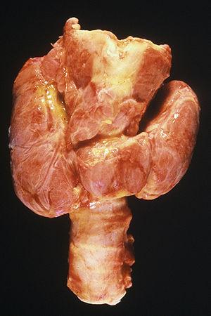 Disorder caused by hyperthyroidism