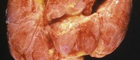 Disorder caused by hyperthyroidism