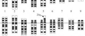 Disorder caused by trisomy