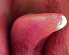 Disorder of the tongue