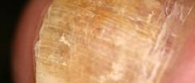 Does Zetaclear work for toenail fungus treatment?