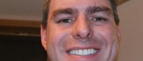 Double chin reduction