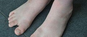 Down syndrome and fitness