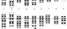 Down syndrome and genetics