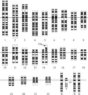 Down syndrome by age of mother