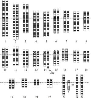 Down syndrome genetic cause