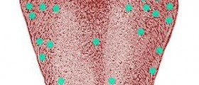 Down syndrome in toddlers: Tongue protrusion