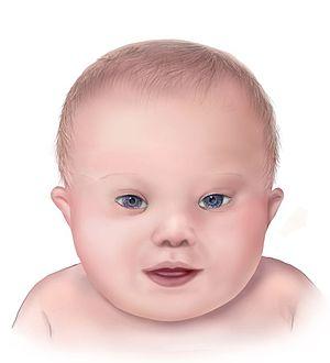 the characteristics of down syndrome a chromosomal abnormality Abnormalities in chromosomal number of human adults (chromosomal abnormality, common name of the (down syndrome, covered. the characteristics of down syndrome a chromosomal abnormality Abnormalities in chromosomal number of human adults (chromosomal abnormality, common name of the (down syndrome, covered.