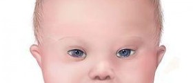 Down syndrome newborn characteristics