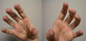Down syndrome sing on fingers
