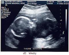 Down syndrome ultrasound test