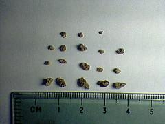 Drug abuse and kidney stones